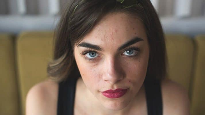 acne scarring cause female