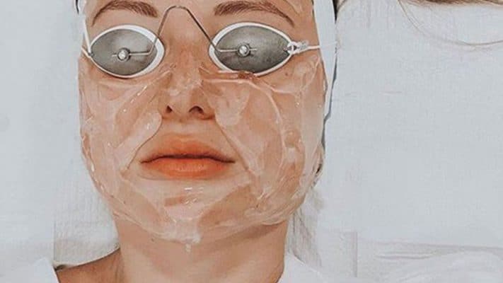 laser treatment acne scars