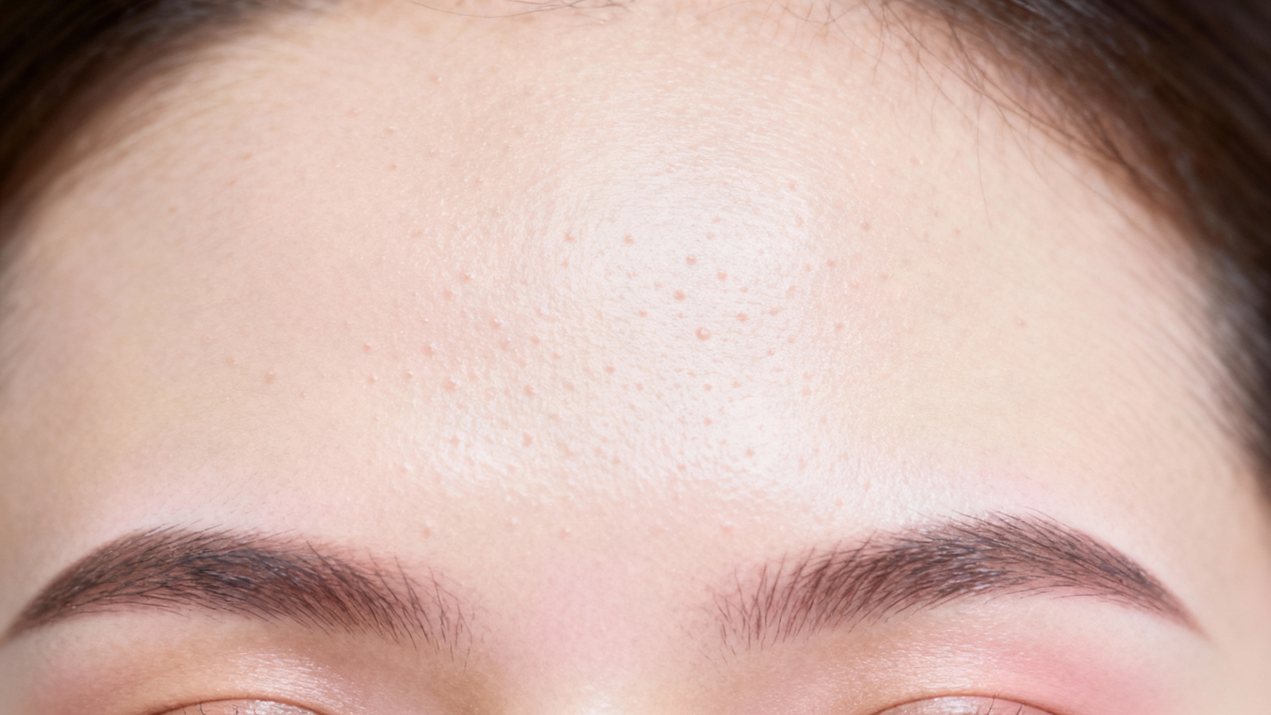Featured image for What causes forehead acne?