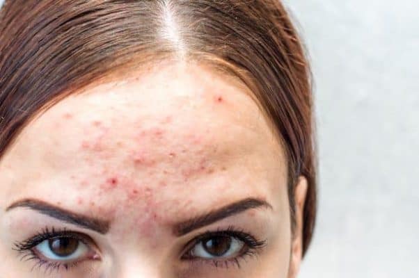 fungal acne appearance